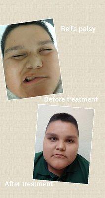 Bell's palsy patient