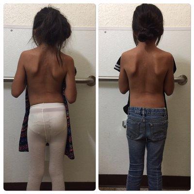 Case of "rye neck"/scoliosis after 1 treatment!! This little girl knows when she feels great!