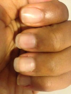 This is what my nails looked like a few days after getting the acrylic done.

Chipping/cracking along the sides of the nails.