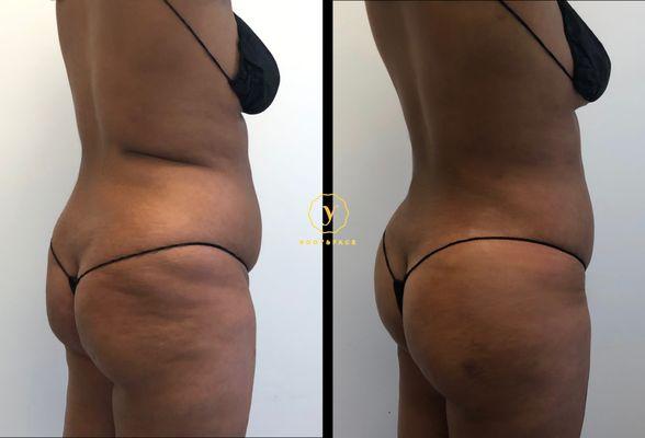 Liposuction and BBL to enhance the gluteal curve.