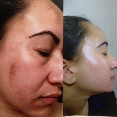 Pigmentation treatment