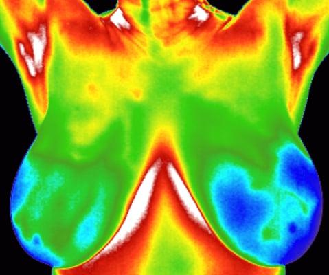 Thermographic scan of normal breast tissue