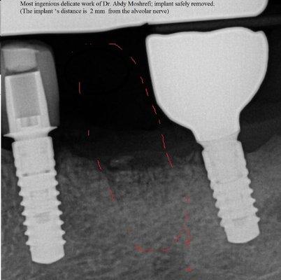 Implant removed. Life threatening surgery performed by a skillful doctor without any harm to IAN nerve.