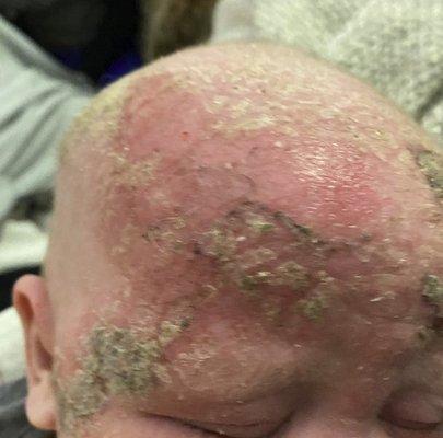 Burned skin from 2.5% hydrocortisone, which afterwards has caused a severe fungal infection on top of it.