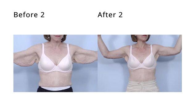 Brachioplasty (arm lift) Before and After