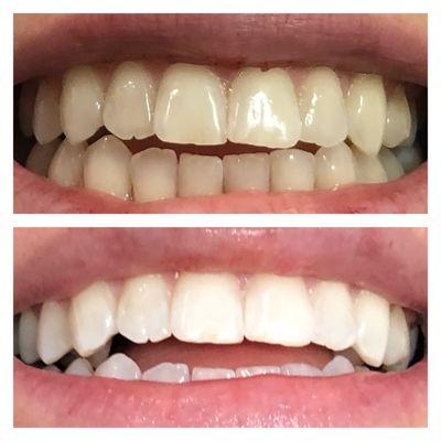 SmileLabs Teeth Whitening