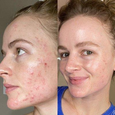 Acne Bootcamp Results