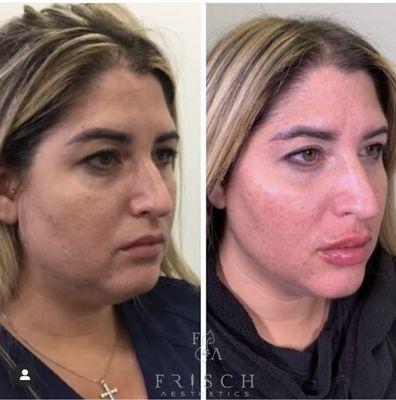 Perfectly placed injectables can contour and reshape