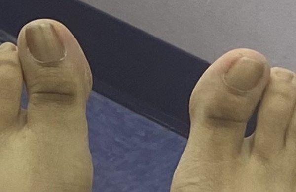 Toes with hidden ingrowns