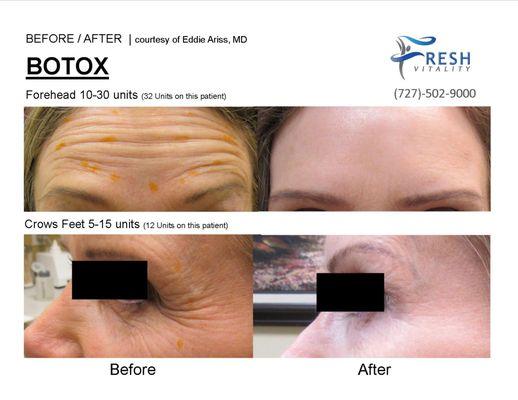 Botox Cosmetic-Real FDA Approved  Forehead Lines & Crow's Feet Treatment