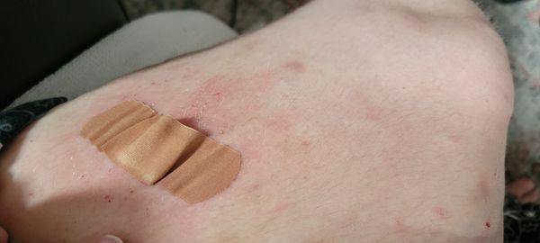 I had a biopsy done to find out what it is heat rash or other to find best course of treatment