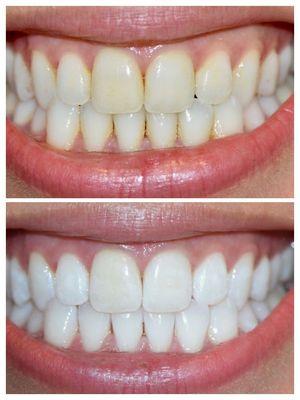 Before and after In-Office Teeth Whitening