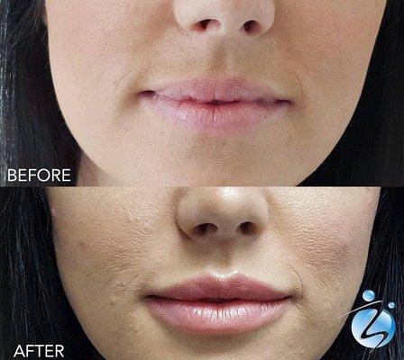 Lip Augmentation