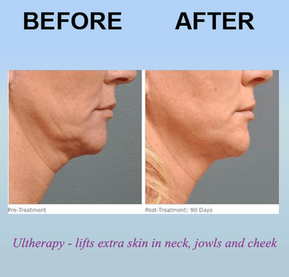 Ultherapy - lifts extra skin in neck, jowls and cheek