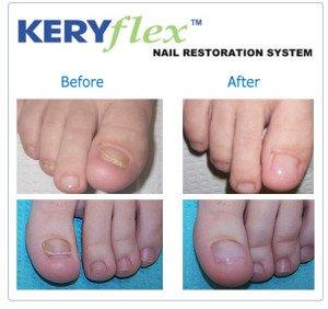 Damaged toenails? We can restore them!