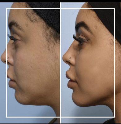 Say goodbye to that double chin! We use the hyaluron pen that melts chin fat without needles, pain, or downtime. 1 or more treatment needed.