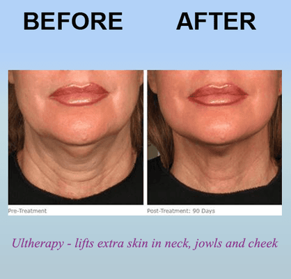 Ultherapy - lifts extra skin in neck, jowls and cheeks