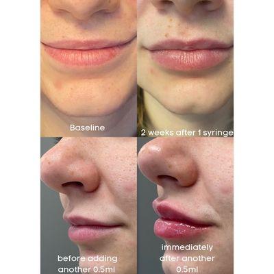 Lip filler journey :)