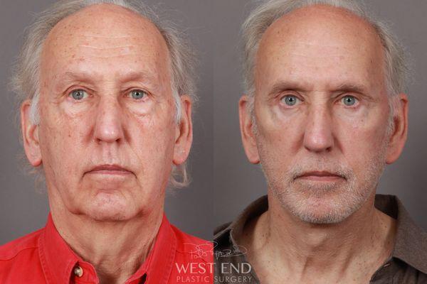 Dr. Ruff performed a Deep Plane Facelift & Neck Lift, Eyelid Lift, Fat Grafting, and CO2 Resurfacing. The patient is 5 Months Post-Op.