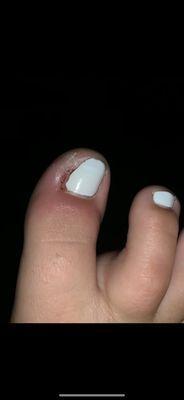 My toe infection after their "luxurious" pedicure... DO NOT GO HERE. Unless you are okay with being unable to walk.