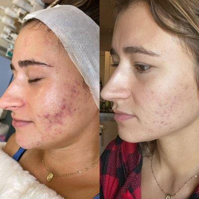 Acne Bootcamp Results