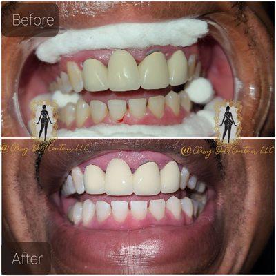 This treatment will whiten and brighten your teeth in 30-120 minutes. The teeth will be protected with a barrier while whitening.