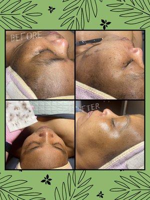 Derma-plane facial