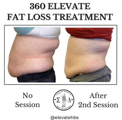 Transformation on 2 sessions with out 360 Fat Loss Treatment with a duration of 1 hour.