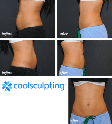 Examples of Collsculpting results