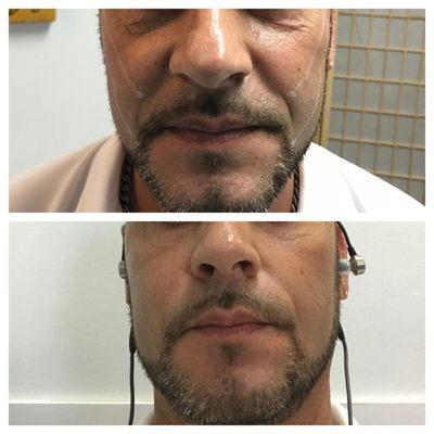 Before and after PDO thread lift. The after picture was taken 3 weeks post procedure.