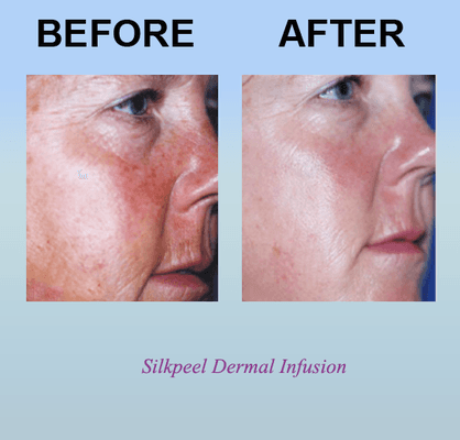 Silkpeel Dermal Infusion