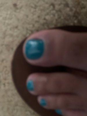 Irritated big toe after the pedicure