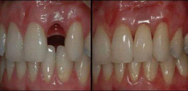 Dental bridge