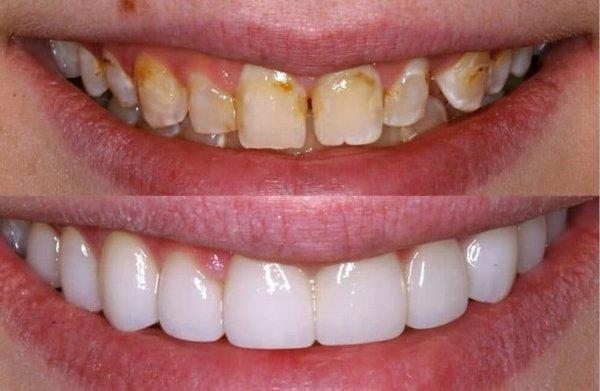 VENEERS UPPER AND LOWER