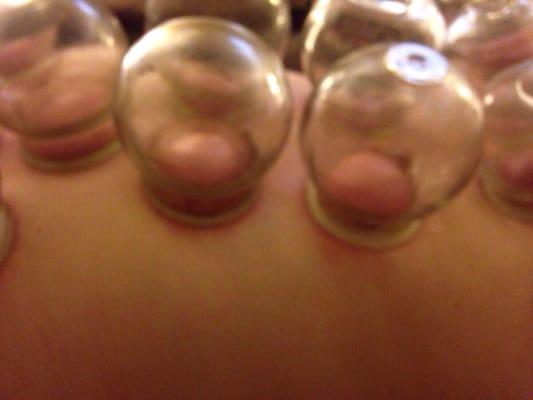 Traditional Chinese Medicine uses Cupping to release Myofascial binding and move Qi and blood.