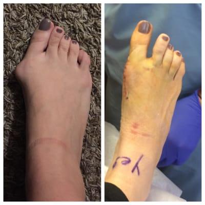 Left is night before surgery and right is exactly a week later. Such an improvement already!