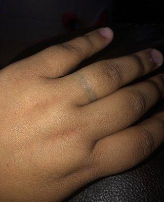 This is her hand after take off the ring