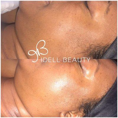 Idell Beauty Micro-Peel