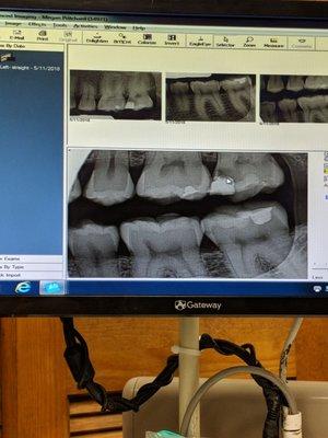 X-ray at the new dentist where it's pretty obvious I have an issue! (Bright white & dark area)