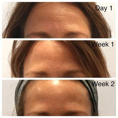 Brow Botox results