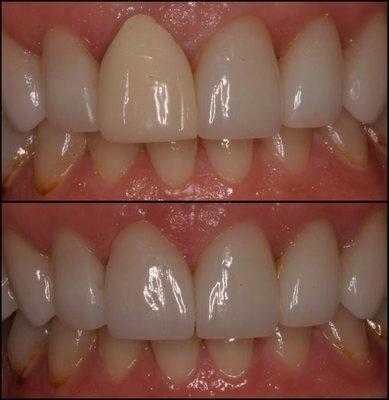 Before and After. Fixing old crowns with poor esthetics.  Lower Picture is a very Happy Patient.