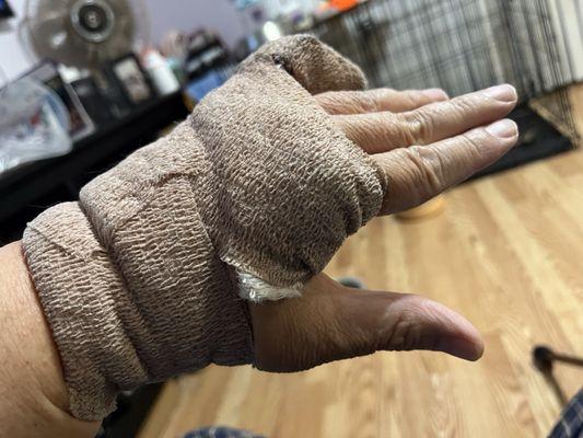 My hand following surgery on the pinky. You can the splint buried under the bandage wrap.