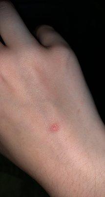 Bed Bug Bites