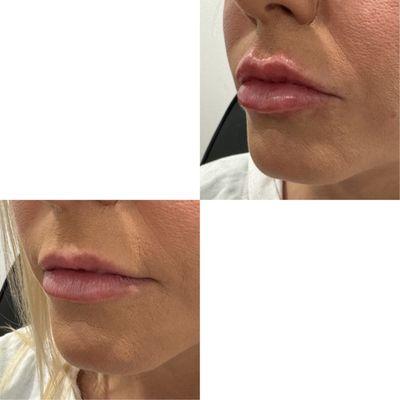 Lip Filler