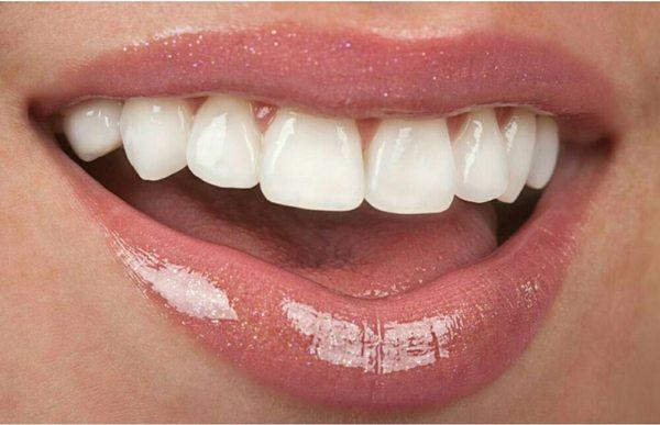 Professional Teeth Whitening done by Cametra