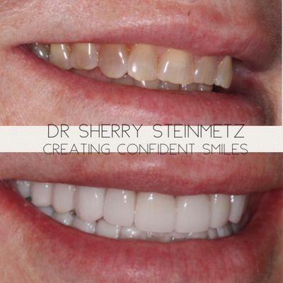 Before and after porcelain veneers by Dr. Sherry Steinmetz