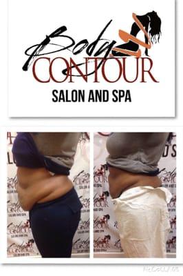 Before and After  Body Contour Treatment  Call: 7862547972  for your free consultation