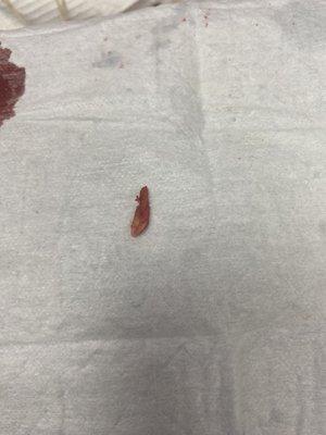 Ingrown nail extracted