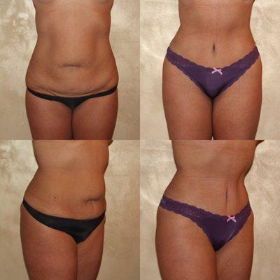 Abdominoplasty Tummy Tuck