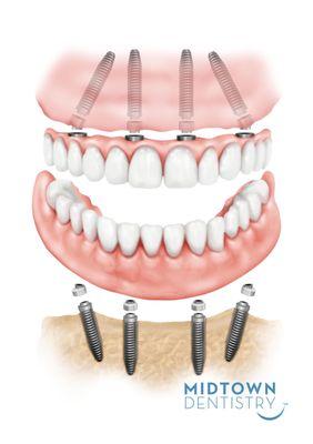 Dental Implants to replace missing teeth